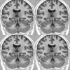 A Bayesian Approach to Image Restoration