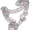 A Variational Framework For 3d Colonic Polyp Visualization In Virtual Colonoscopy