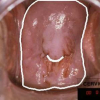 Automatic landmark detection in uterine cervix images for indexing in a content-retrieval system