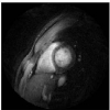 Reconstruction of undersampled dynamic spiral MR images